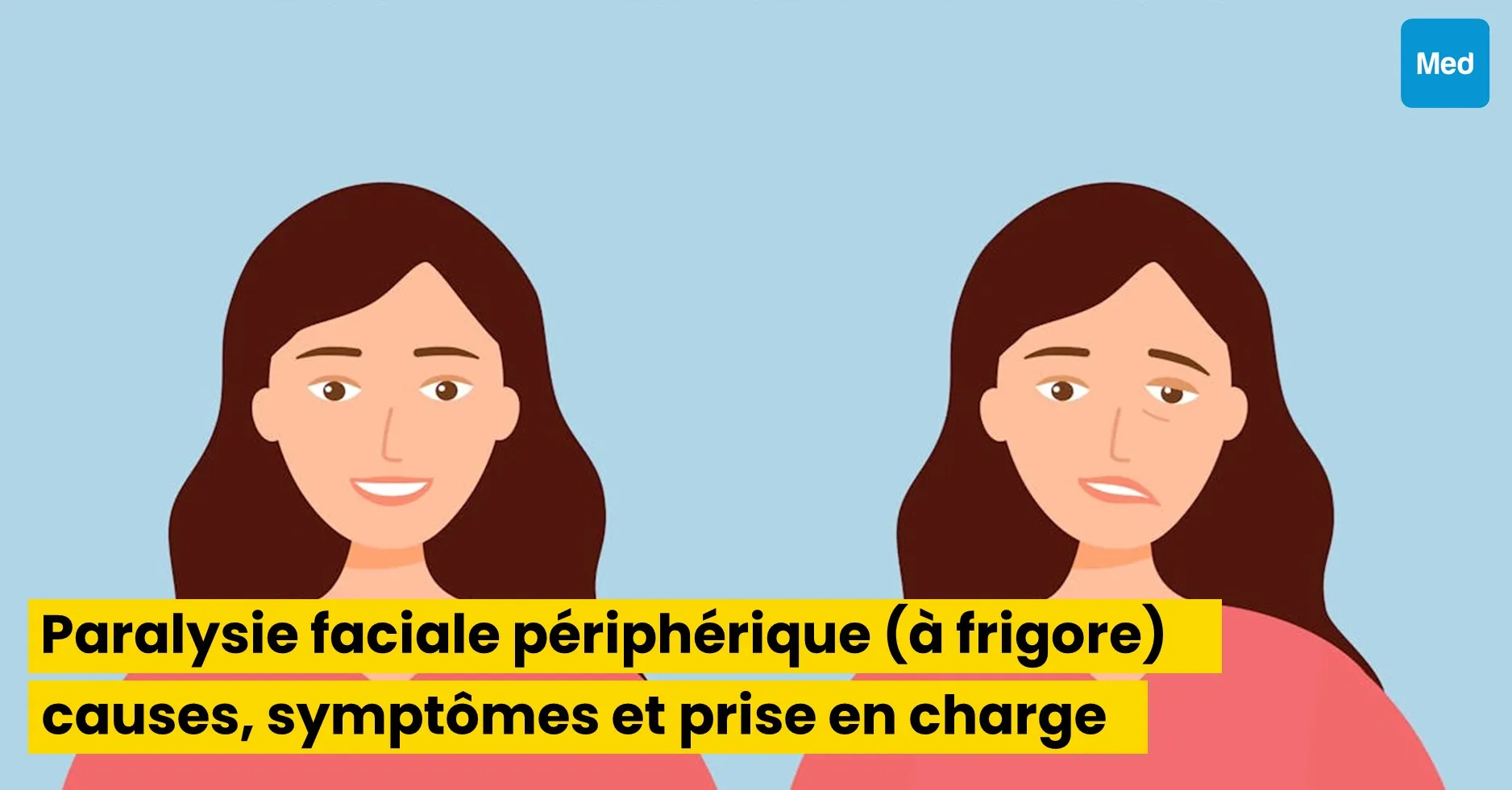 Paralysie faciale périphérique (à frigore) : causes, symptômes et prise en charge